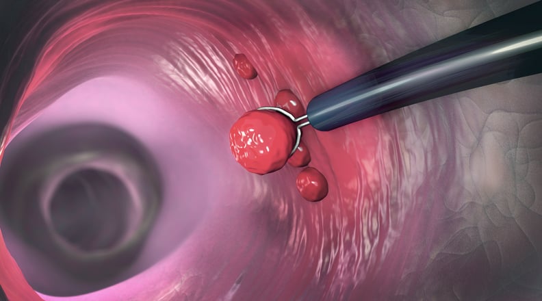 Covid-19 e tumore del colon-retto: non rimandare lo screening
